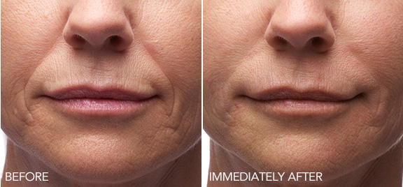 View the transformations from quality dermal fillers of Belotero Balance in South Holland, IL. Dermal Filler Transformations