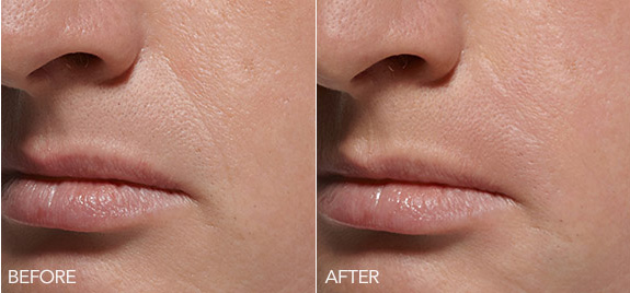 View the patient transformations from effective dermal fillers of Belotero Balance in South Holland, IL. Dermal Filler Patient Transformations