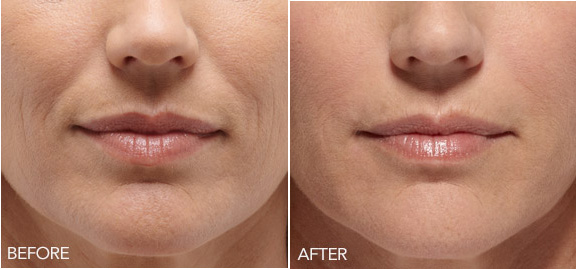 View the highly effective transformations from dermal fillers of Belotero Balance in South Holland, IL. Dermal Filler Quality Transformations