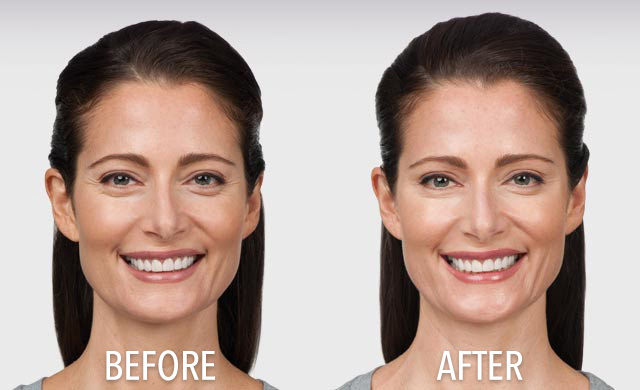 Botox transformation in South Holland, IL for one patient from South Holland Dentistry. Patient Botox Transformation
