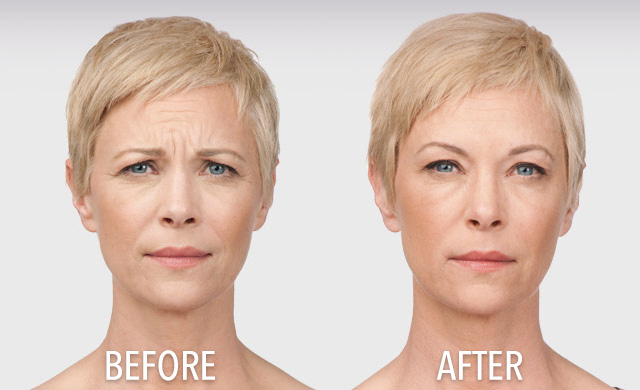 Expert patient botox transformation in South Holland, IL at South Holland Dentistry. Botox Patient Transformation