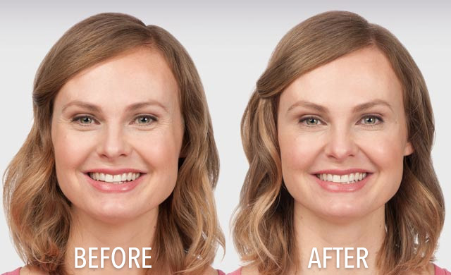 Experienced botox transformation near South Holland, IL for one patient from our knowledgable dental team. South Holland, IL Botox Transformation
