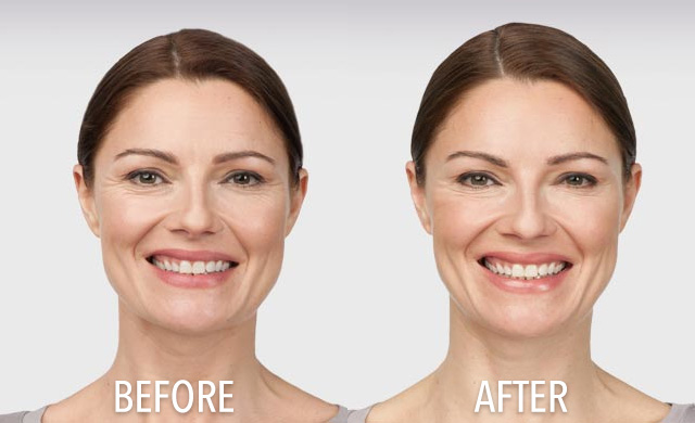 Knowledgable dental team offers medical botox transformation for fine lines and wrinkles in South Holland, IL. Transformation with Botox