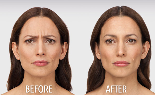 Our high quality dental team offers botox transformation for fine lines and wrinkles in South Holland, IL. Remove Wrinkles with Botox