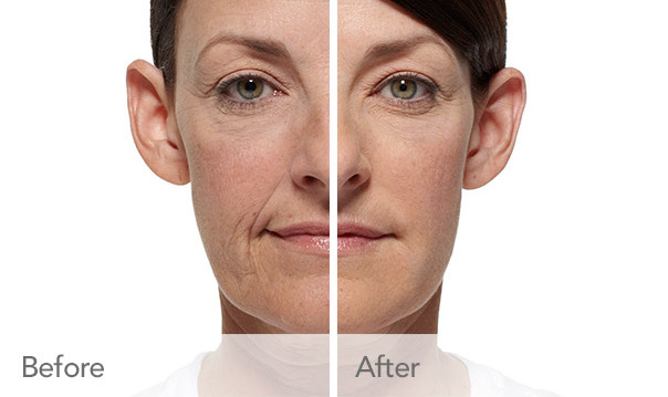 Provide volume and diminish signs of aging with Radiesse near Harvey, IL. Radiesse Transformation