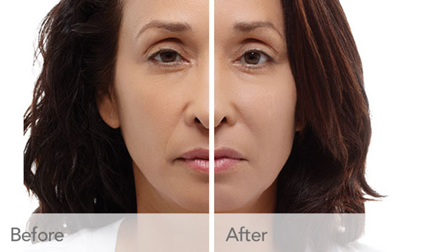 Provide volume and diminish signs of aging with Radiesse near Lansing, IL. Transformation with Radiesse