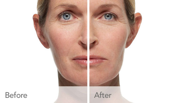 Provide volume and diminish signs of aging with Radiesse near South Holland, IL. Voluminzing with Radiesse