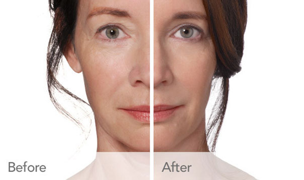 Provide volume and diminish signs of aging with Radiesse in South Holland, IL. Transformation with Cosmetic Radiesse
