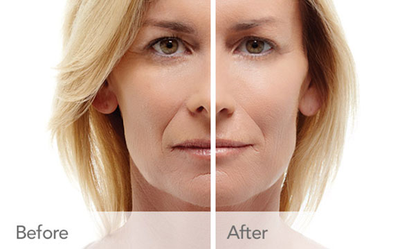 Provide volume and diminish signs of aging with the quality cosmetic Radiesse offered by cosmetic dental expert near Harvey, IL. Transform with Radiesse
