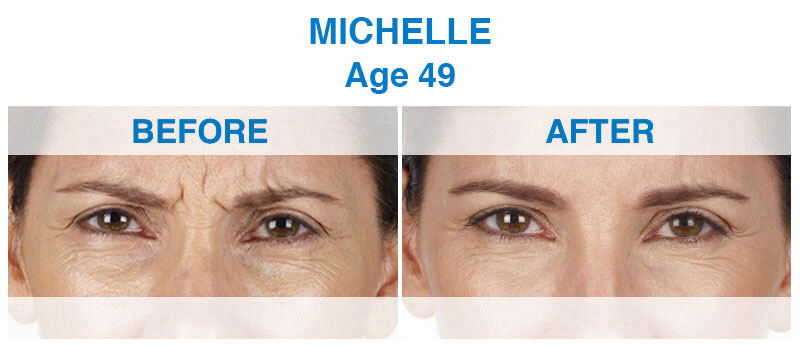 View the before and after patient images from a 49-year-old female cosmetic dentistry patient showcasing the transformation of Xeomin. Before & After Anti-Aging Dental Treatment