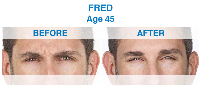 View the before and after patient images from a 45-year-old male cosmetic dentistry patient showcasing the transformation of Xeomin. Before & After Anti-Aging Xeomin Treatment