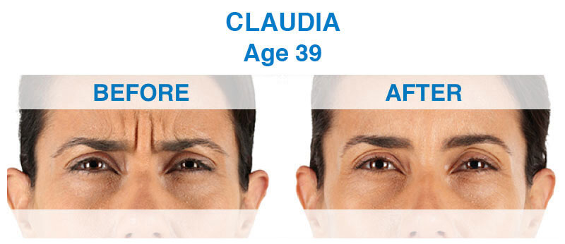View the before and after patient transformations from a 39-year-old female cosmetic dentistry patient showcasing the transformation of Xeomin. Before & After Anti-Aging Patient Transformations