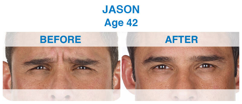 View the before and after patient transformations from a 42-year-old male cosmetic dentistry patient showcasing the transformation of Xeomin. Before & After Male Anti-Aging Xeomin Treatment